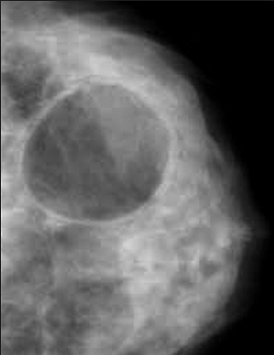 Киста молочной железы, на снимке маммографии